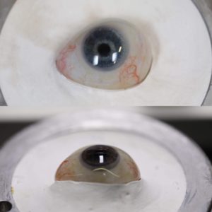Ocularist Dwayne Collins answers the question how often does a prosthetic eye need to be replaced